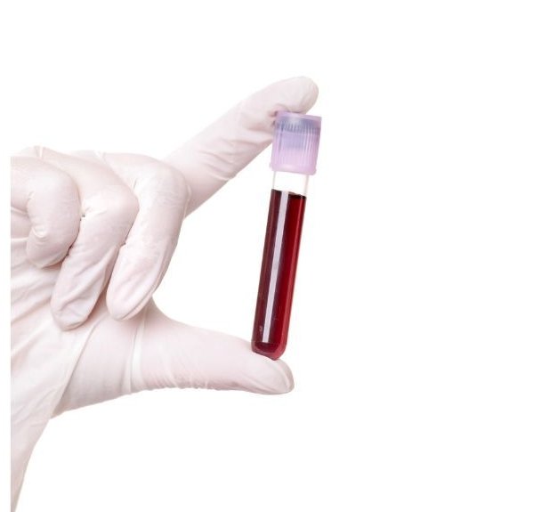 How to Estimate Serum Bilirubin by   Colorimeter?